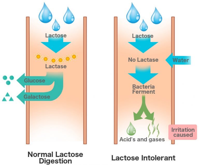 What Is Lactose Intolerance? What Are Its Causes, Symptoms And Signs?