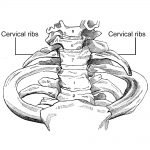 What Are Cervical Ribs? Are They Dangerous?