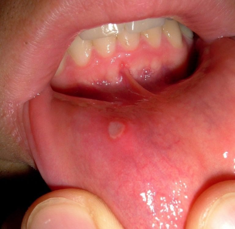 Aphthous Stomatitis: Definition, Types, Causes, and Treatment